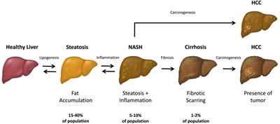 Cell-Free Circulating Nucleic Acids as Early Biomarkers for NAFLD and NAFLD-Associated Disorders